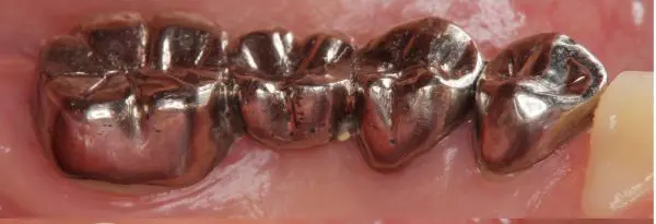 金パラって何？ 被せ物について（金と銀） | 北名古屋市【虫歯治療・小児歯科・口腔外科】水野歯科クリニック